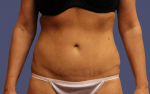 Abdominoplasty (Tummy Tuck) 8 After